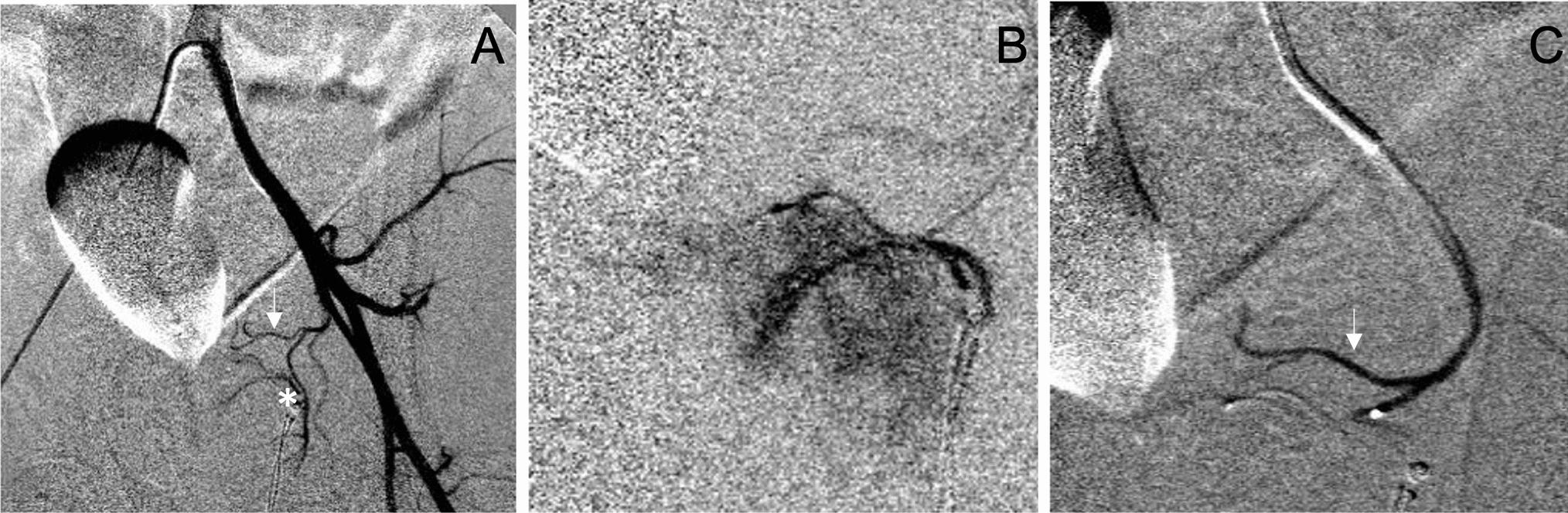 “A Global Podium to the Gold Medallist”: “History of Prostatic Artery Embolization—Another Success Story of Interventional Radiology”