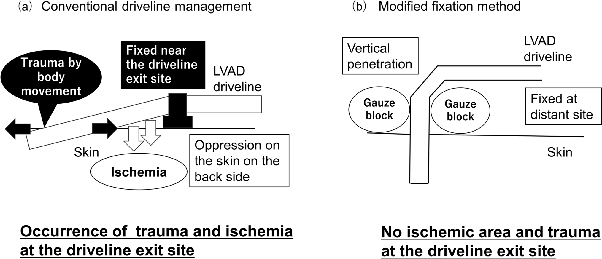 Clinical outcomes of modified left ventricular assist device driveline management