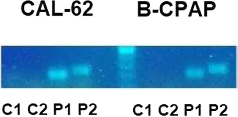 Regulation of PDL-1 expression in thyroid carcinoma cells by tumor cell derived cytokines activating STAT3