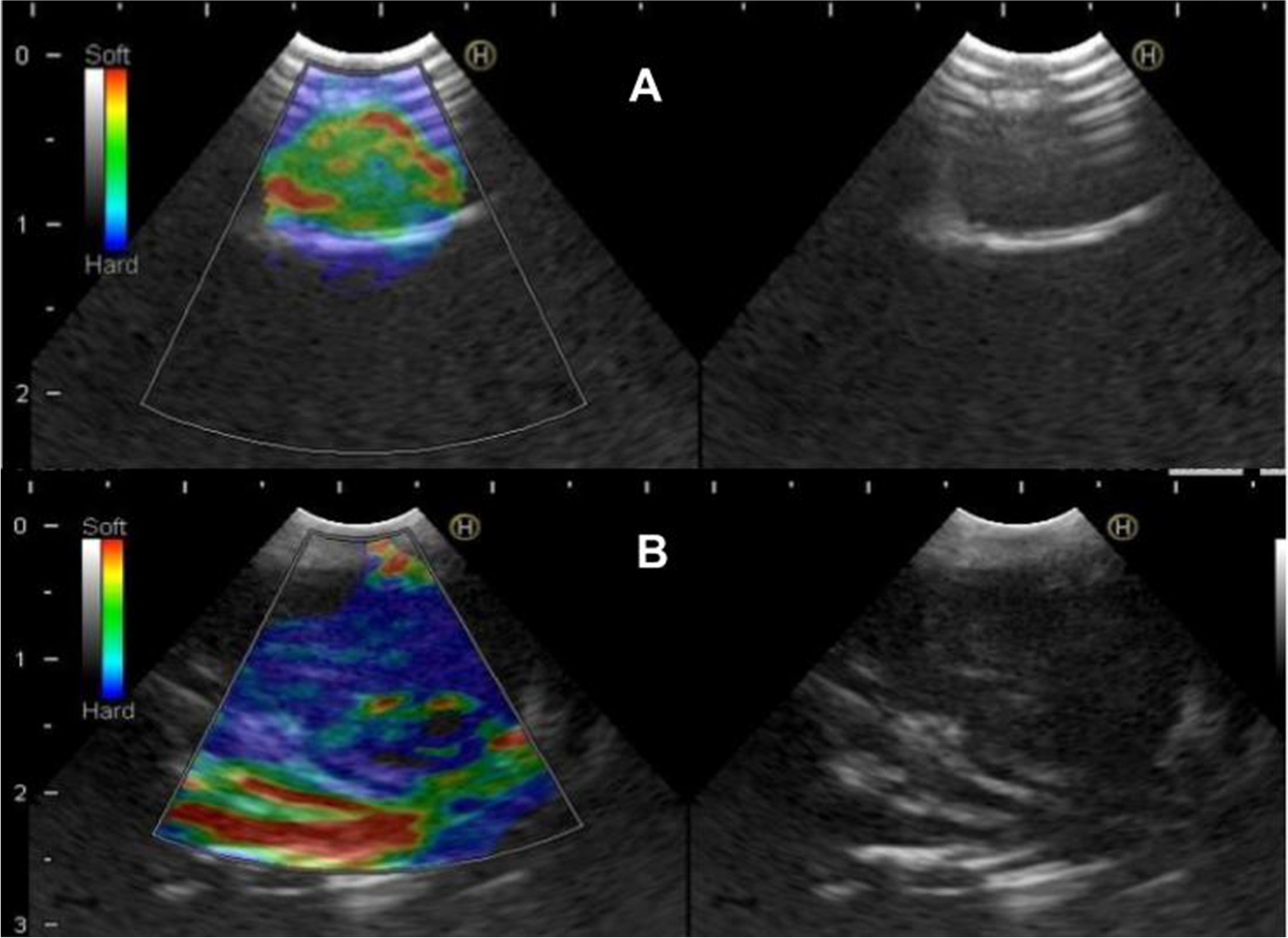 Elastography in EBUS- Useful Tool or Useless Gadget in 2024