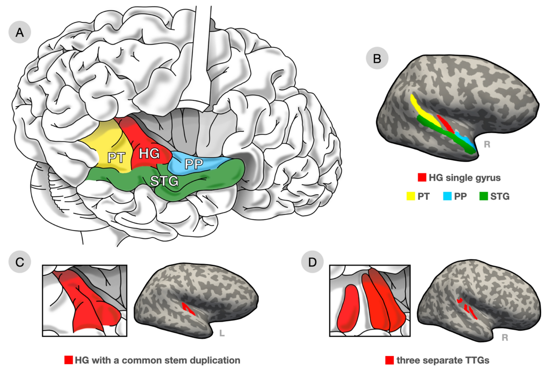 Language aptitude is related to the anatomy of the transverse temporal gyri