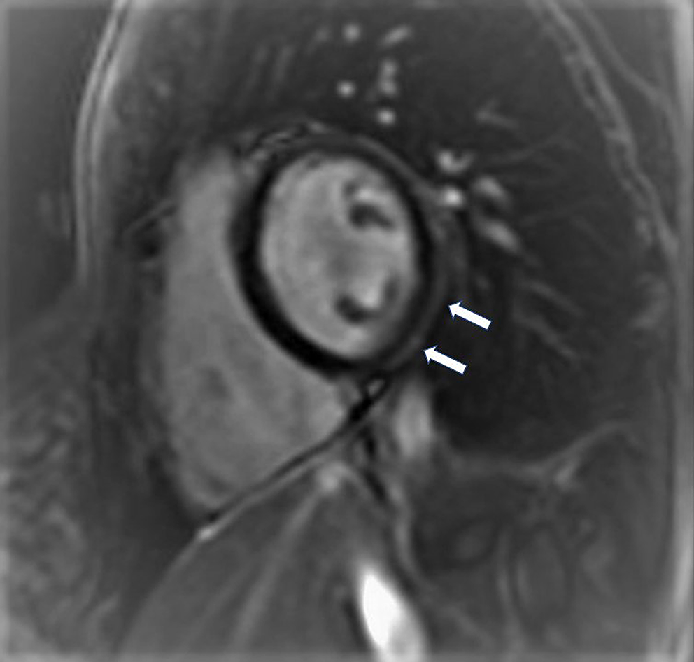 New onset heart failure in adolescents with inflammatory joint disease treated with TNF-α inhibitors: a case-based review