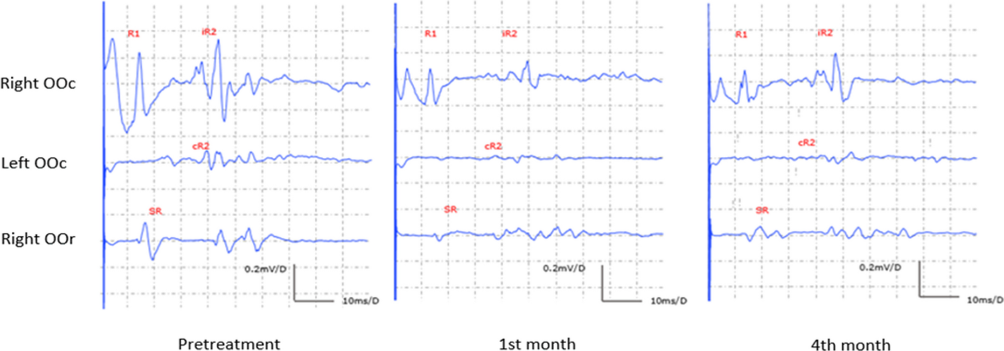 Botulinum toxin modulates the blink reflex via the trigeminal afferent system in hemifacial spasm: an early and late-term effect