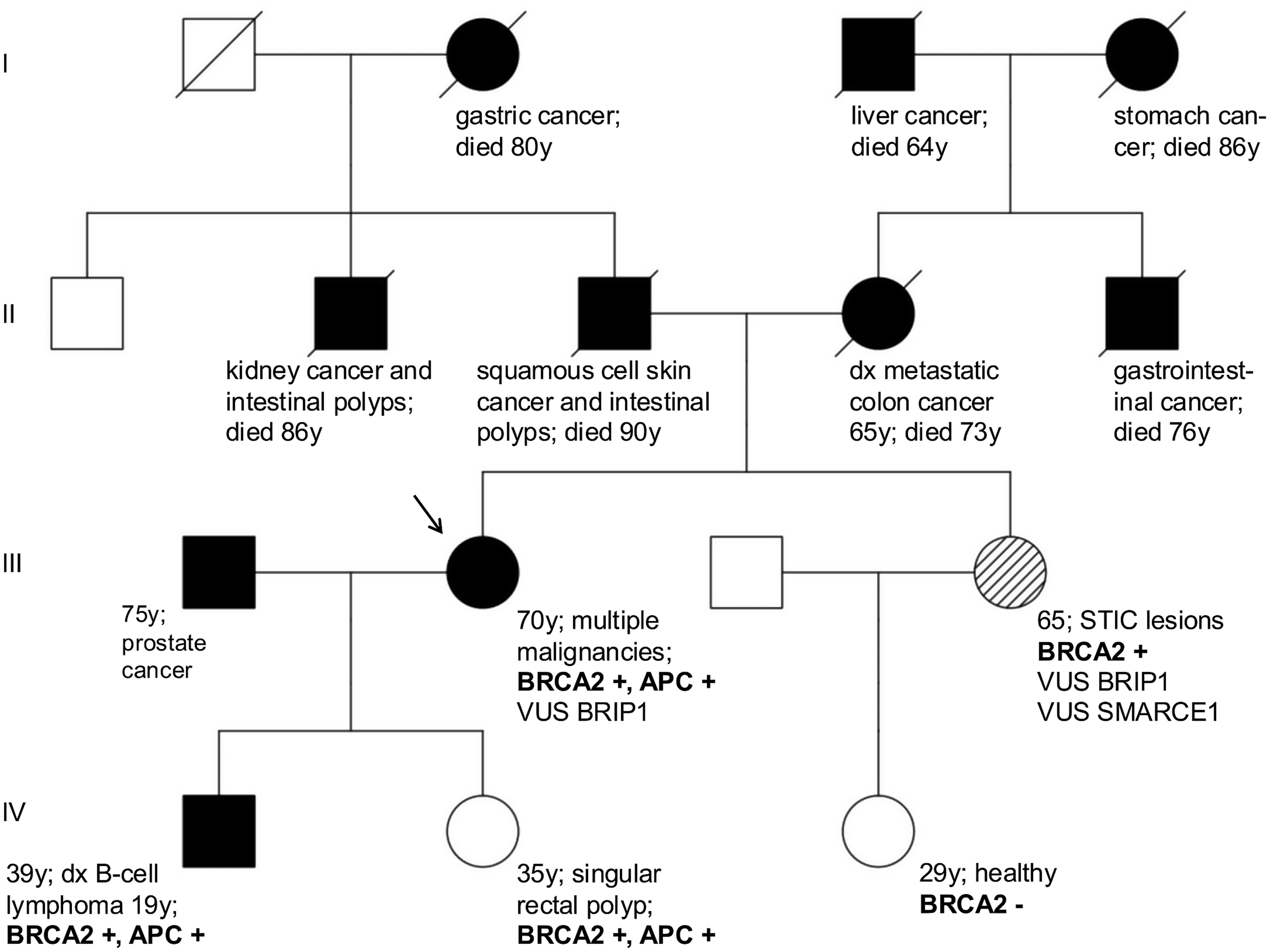 BRCA2 germline mutation carrier with five malignancies: a case report