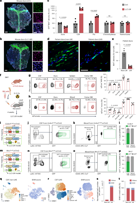 Dura immunity configures leptomeningeal metastasis immunosuppression for cerebrospinal fluid barrier invasion