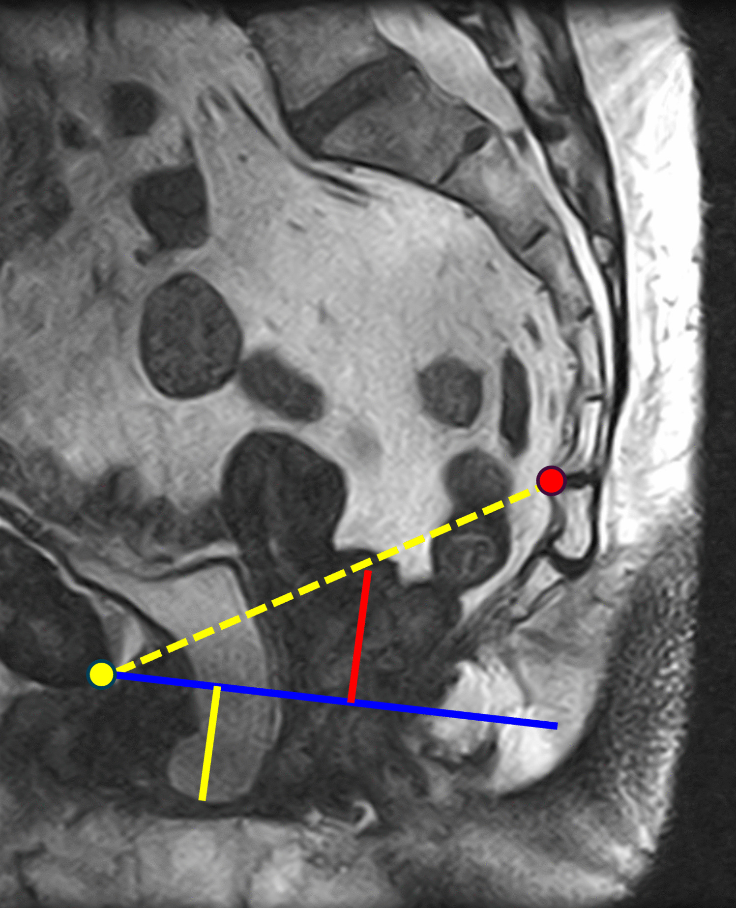 The Effect of Anterior Colporrhaphy: A Prospective Study Comparing POP-Q and Upright MRI