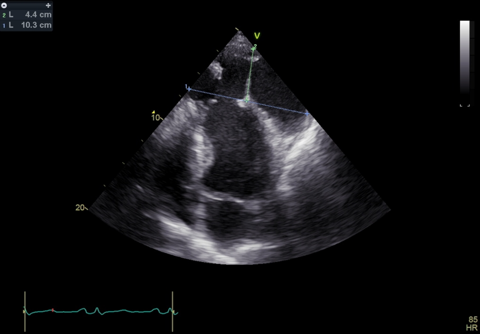 A simplified approach to managing a complex infected left ventricular pseudoaneurysm