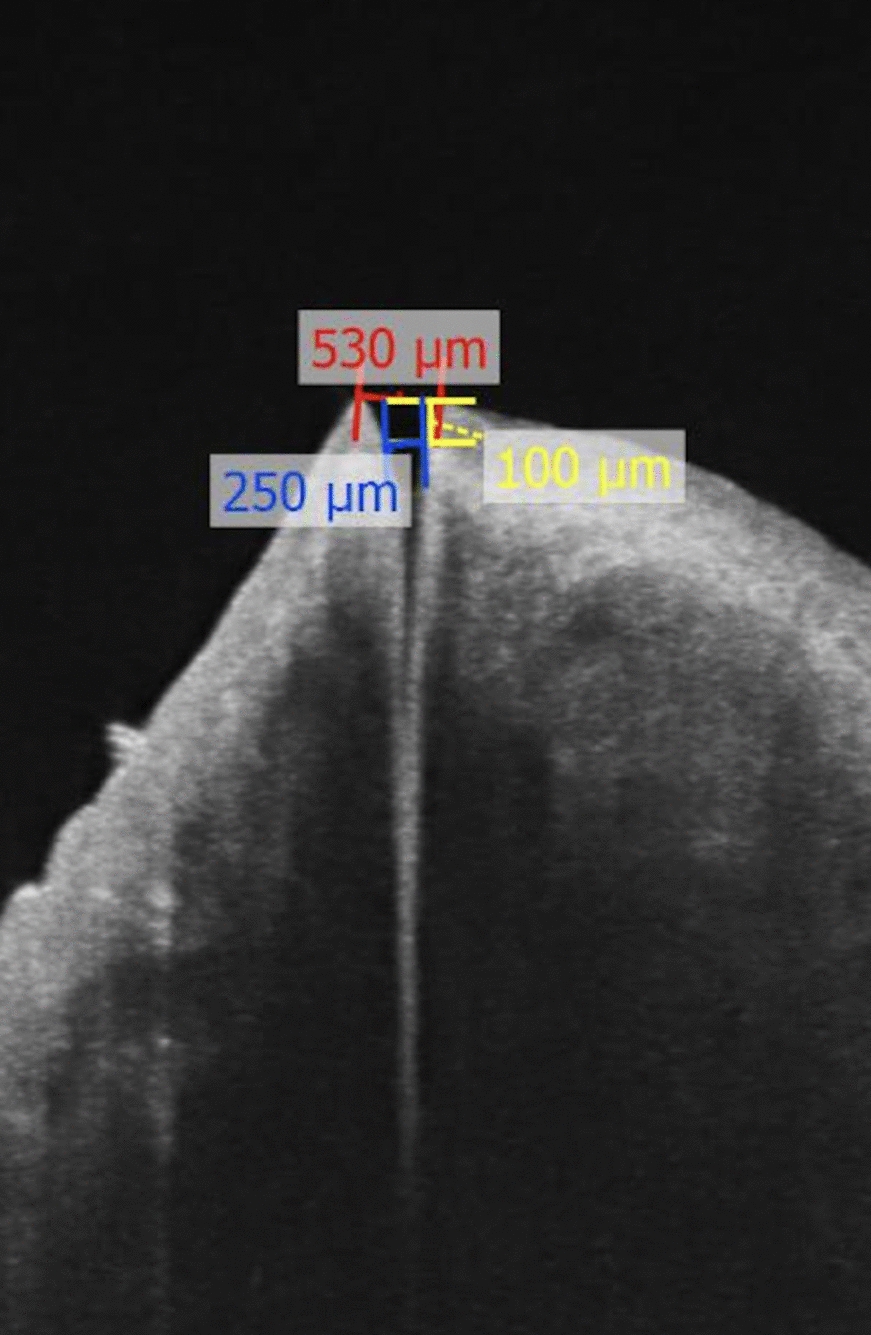 Evaluation of the lacrimal punctum parameters in Turkish population with anterior segment optic coherence tomography