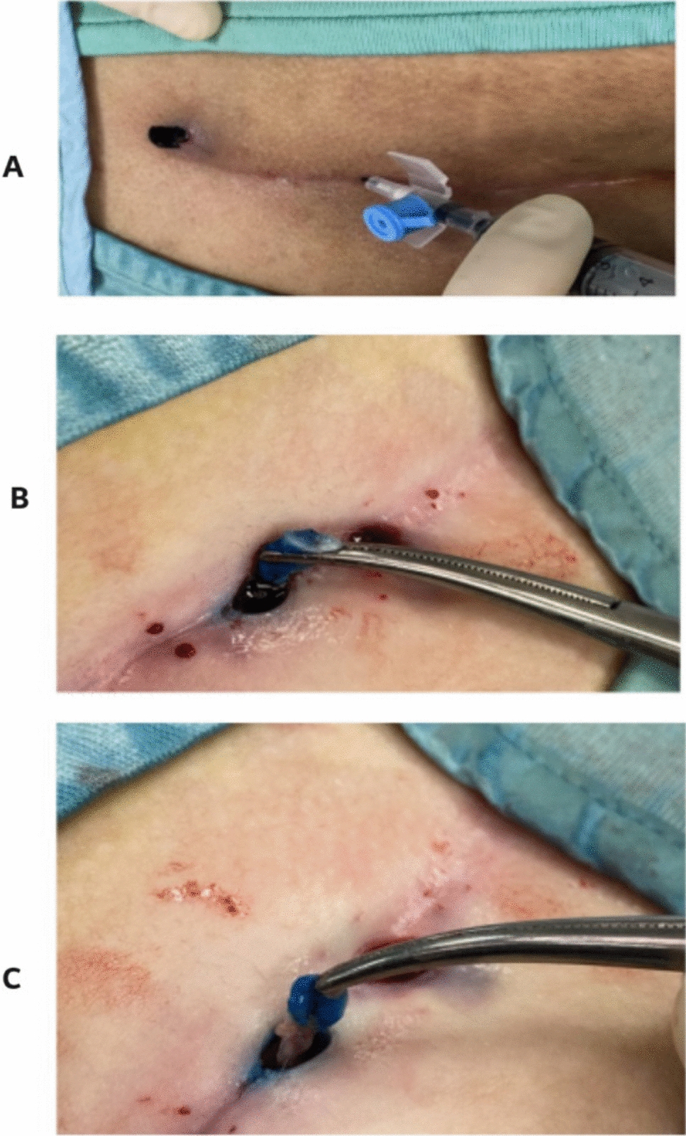 Trephination for primary pediatric pilonidal sinus disease: medium term functional and recurrence outcome of a large cohort