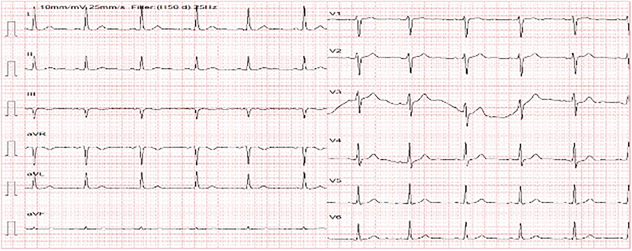 Superiority of photon-counting computed tomography for detecting high-risk unstable angina patients: two case reports