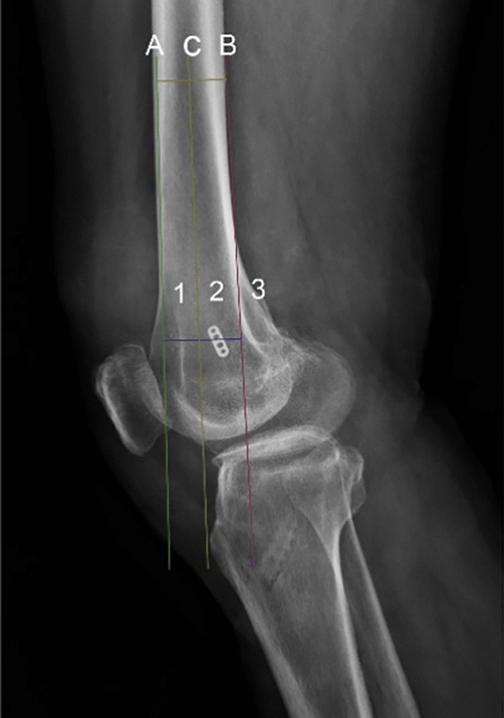 The effect of the position of the femoral endobutton on knee function in the posterior cruciate ligament reconstruction: a retrospective study