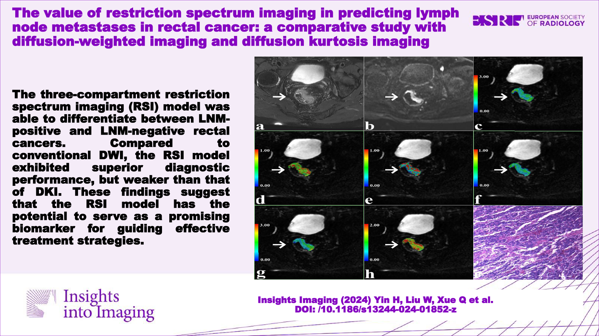 The value of restriction spectrum imaging in predicting lymph node metastases in rectal cancer: a comparative study with diffusion-weighted imaging and diffusion kurtosis imaging