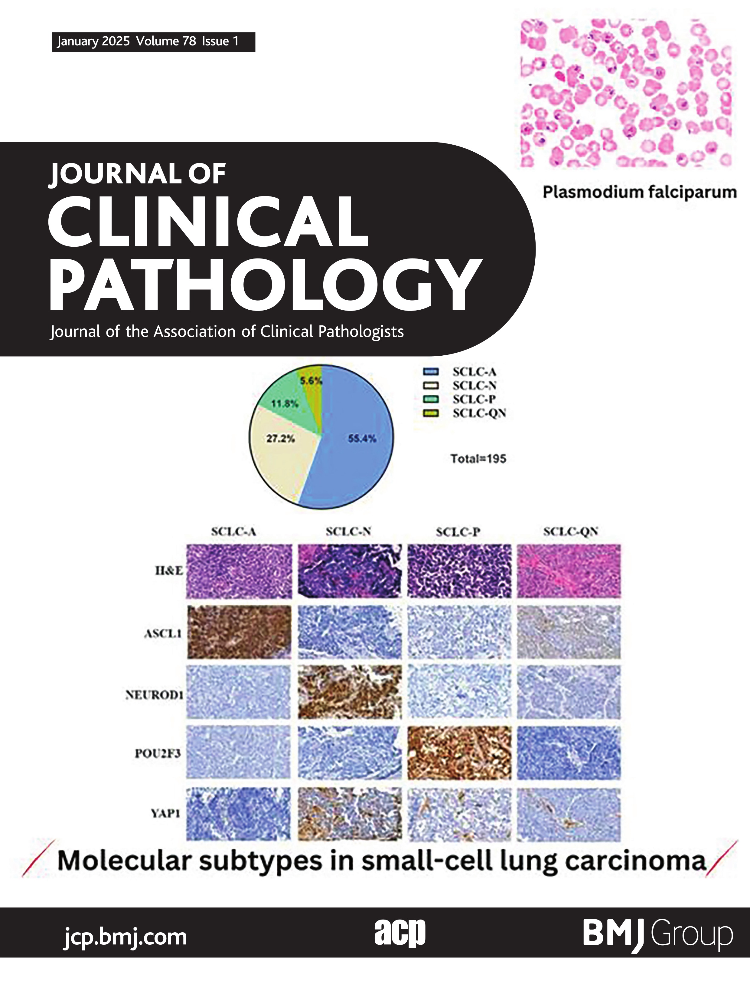 Molecular subtypes, predictive markers and prognosis in small-cell lung carcinoma