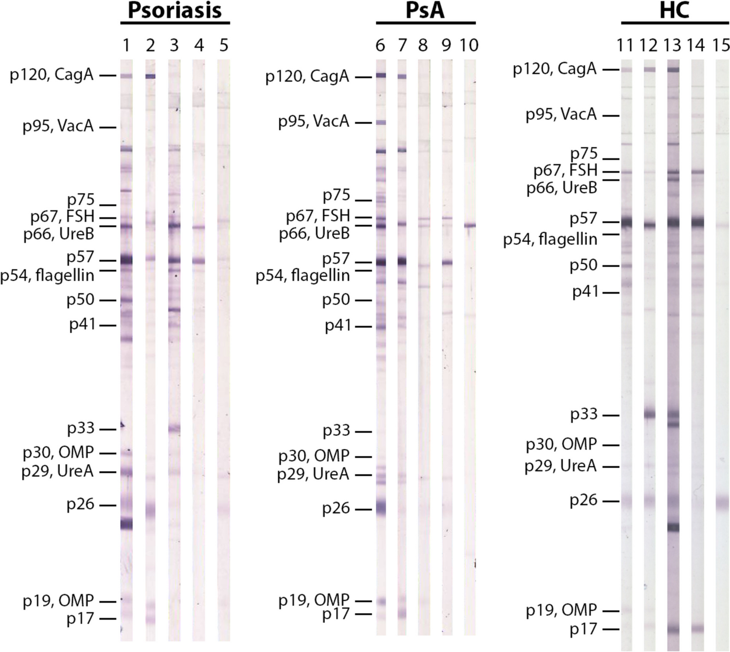 Investigating the link between Helicobacter pylori infection and psoriatic disease: an immunological study