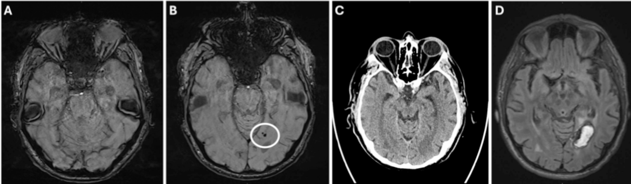 Intracerebral hemorrhage following mild ARIA-H in an APOE ε2 carrier receiving lecanemab