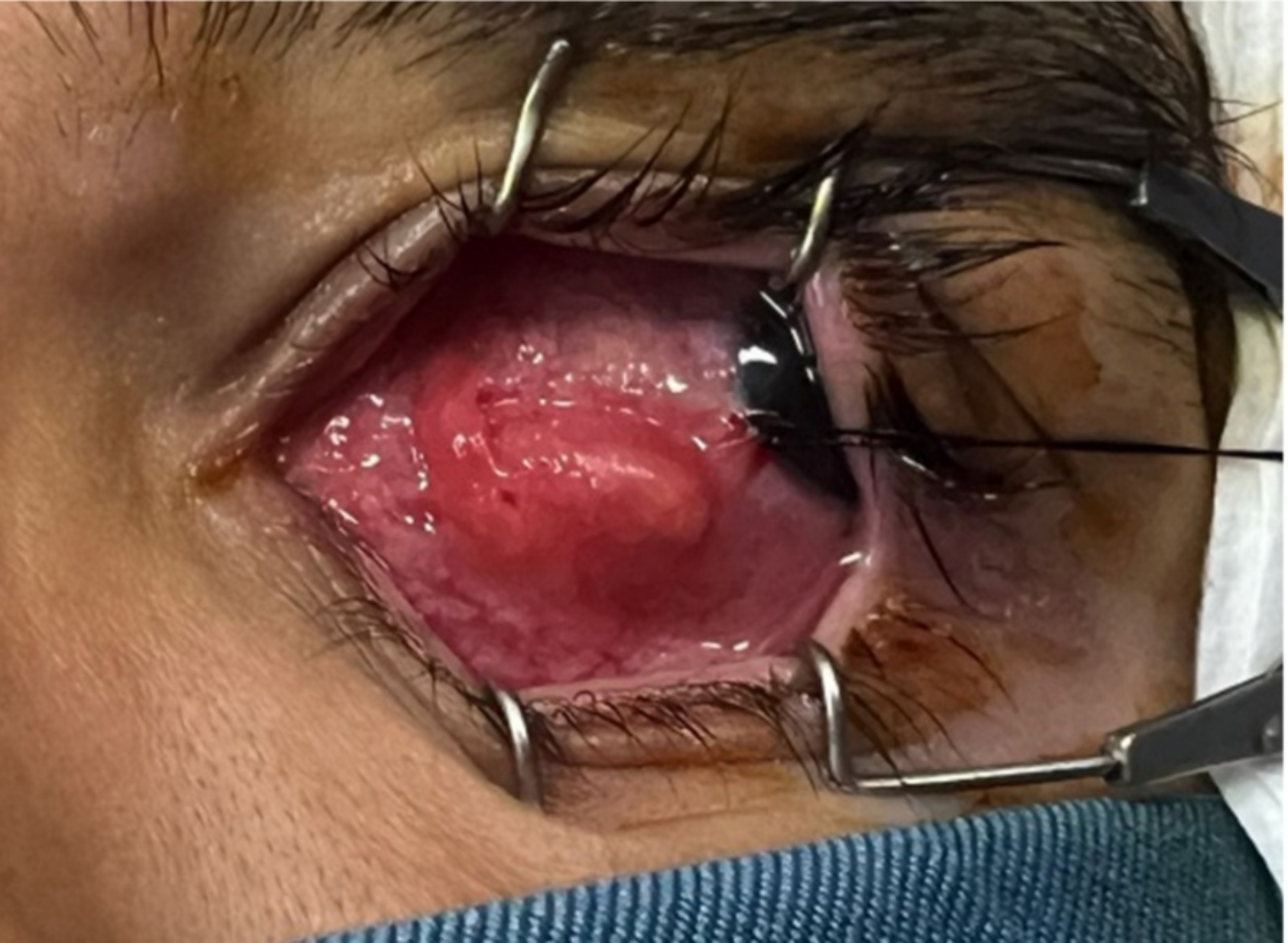 Subconjunctival dirofilariasis in a healthy subject: a case report