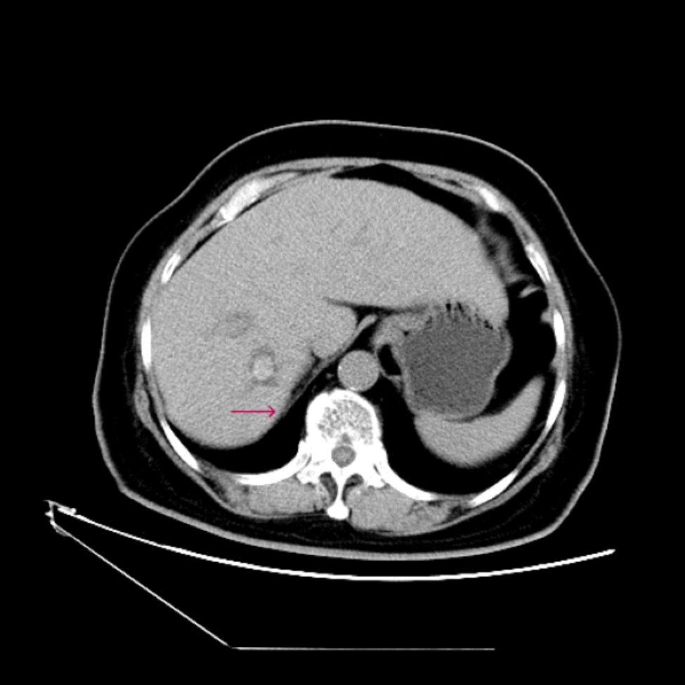 Late onset of biliobronchial fistula — a serious complication of hemihepatectomy for atrophic liver with hepatolithiasis: a case report and review of the literature