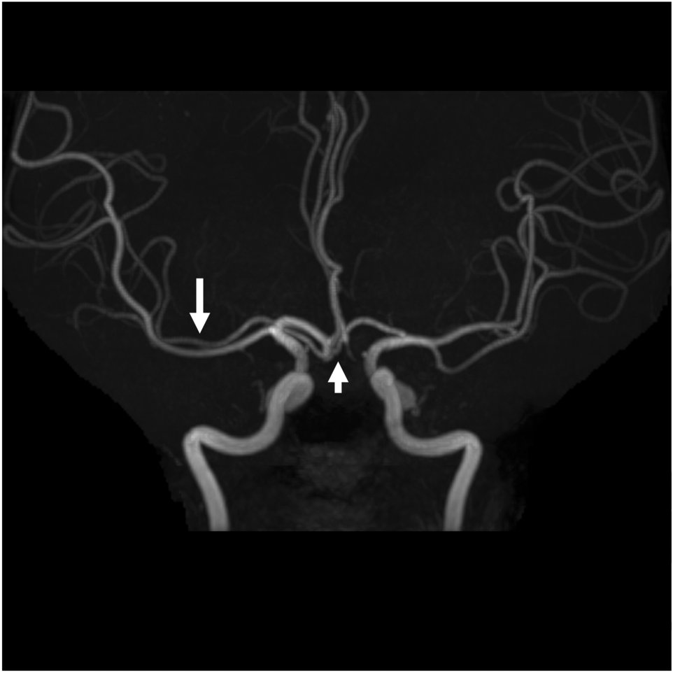 Accessory middle cerebral artery of distal origin associated with an anterior communicating artery duplication that mimicked an aneurysm