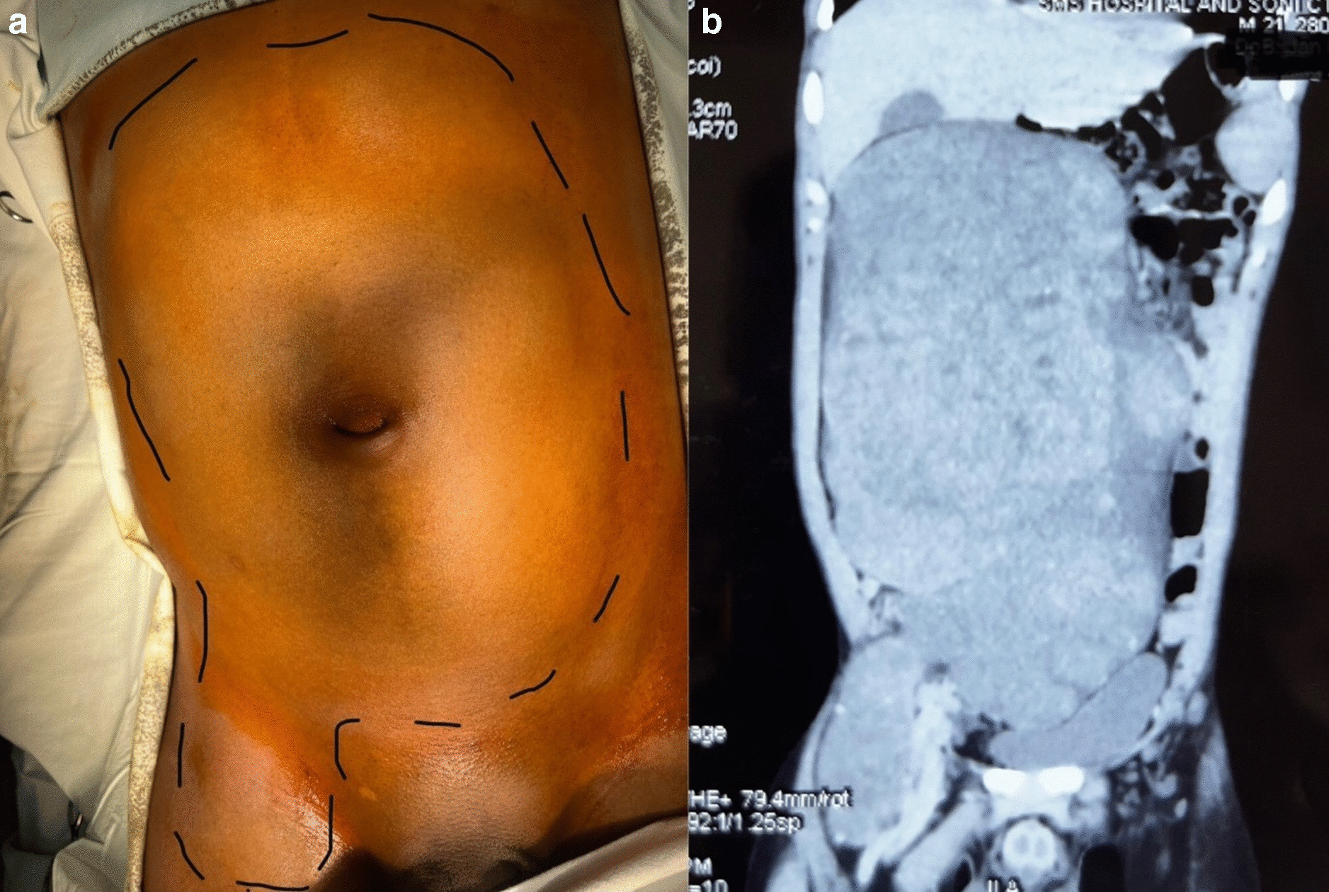 From Fear to Victory: Surgical Triumph over the Largest Reported Giant Retroperitoneal Schwannoma -Images