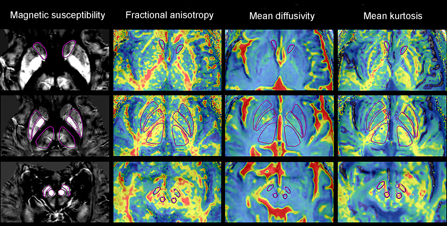 Utilizing combined quantitative multiparametric MRI as potential biomarkers for improved early-stage parkinson’s disease diagnosis