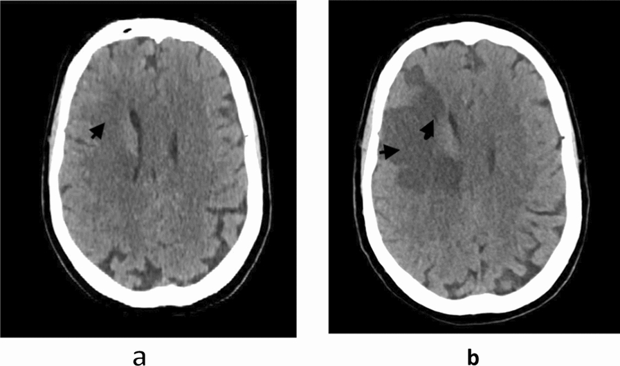 Concurrent acute myocardial infarction and acute ischemic stroke in a diabetic patient undergoing chemotherapy for non-Hodgkin lymphoma: Should I administer thrombolytic therapy? A case report