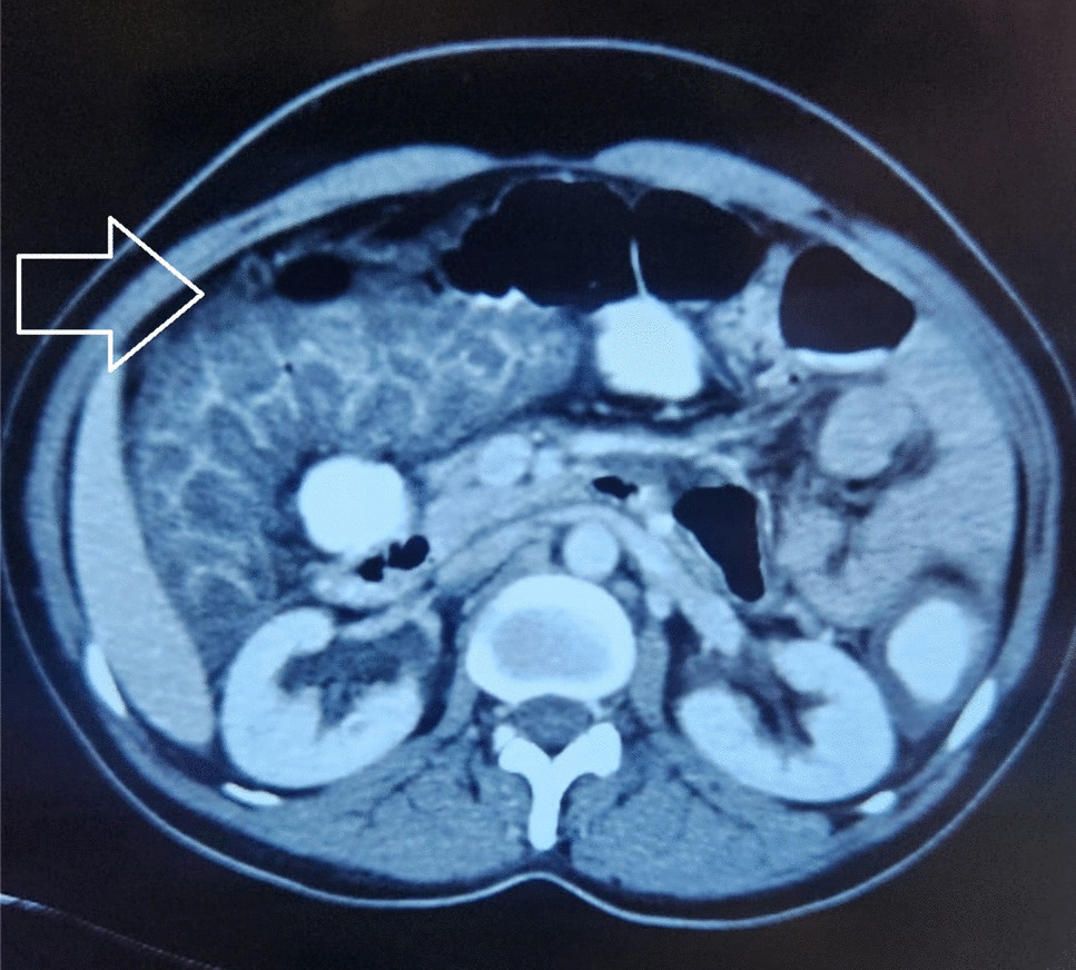 Pseudomembranous Enterocolitis: A Rare CT Finding