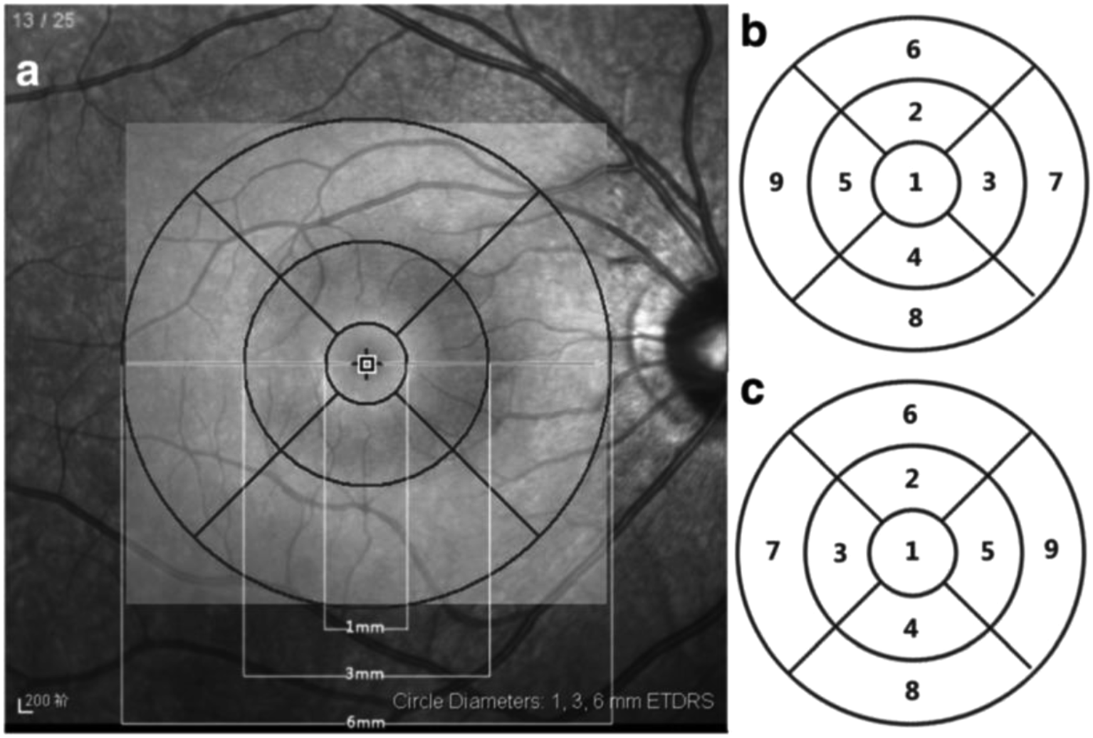 Early response of anti-vascular endothelial growth factor (anti-VEGF) in diabetic macular edema (DME) management: microperimetry and optical coherence tomography (OCT) findings: a pilot study at national eye center of third world country