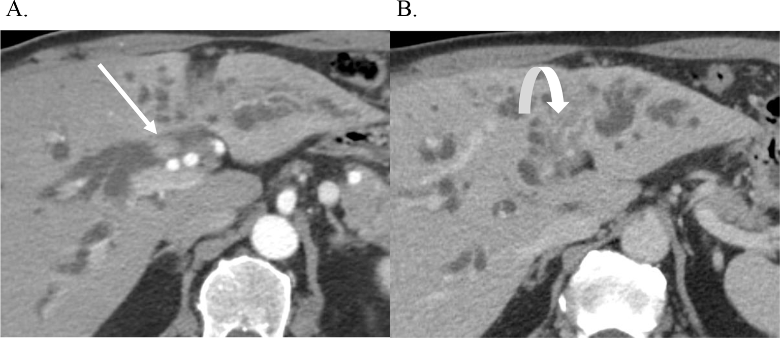 Standardizing the reporting of cholangiocarcinoma: the society of abdominal radiology disease focused panel on cholangiocarinoma lexicon