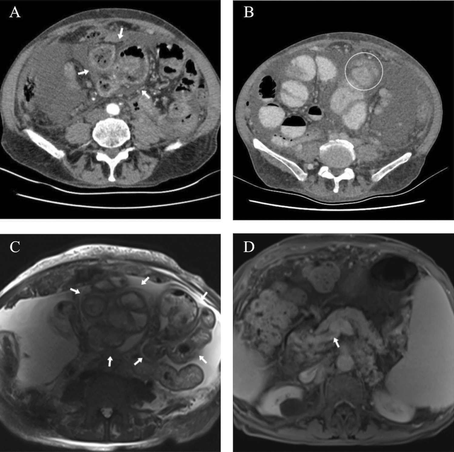 Encapsulating Peritoneal Sclerosis: The Consequence of Recurrent Spontaneous Bacterial Peritonitis