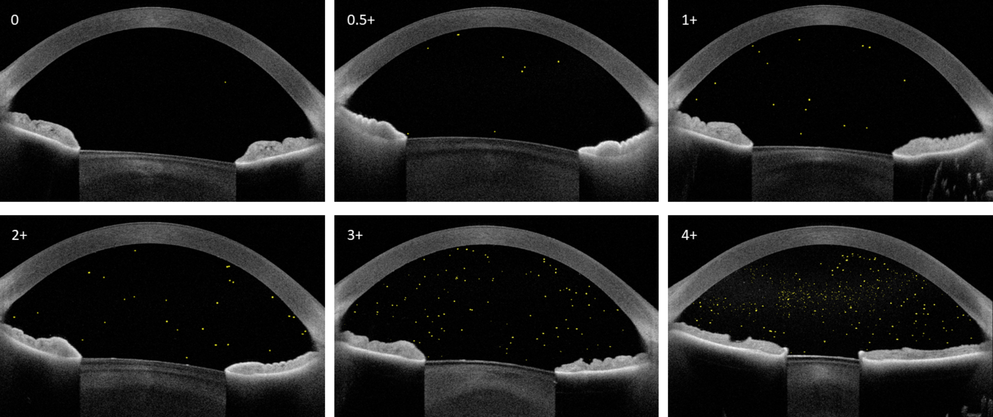 Automated quantification of anterior chamber cells using swept-source anterior segment optical coherence tomography