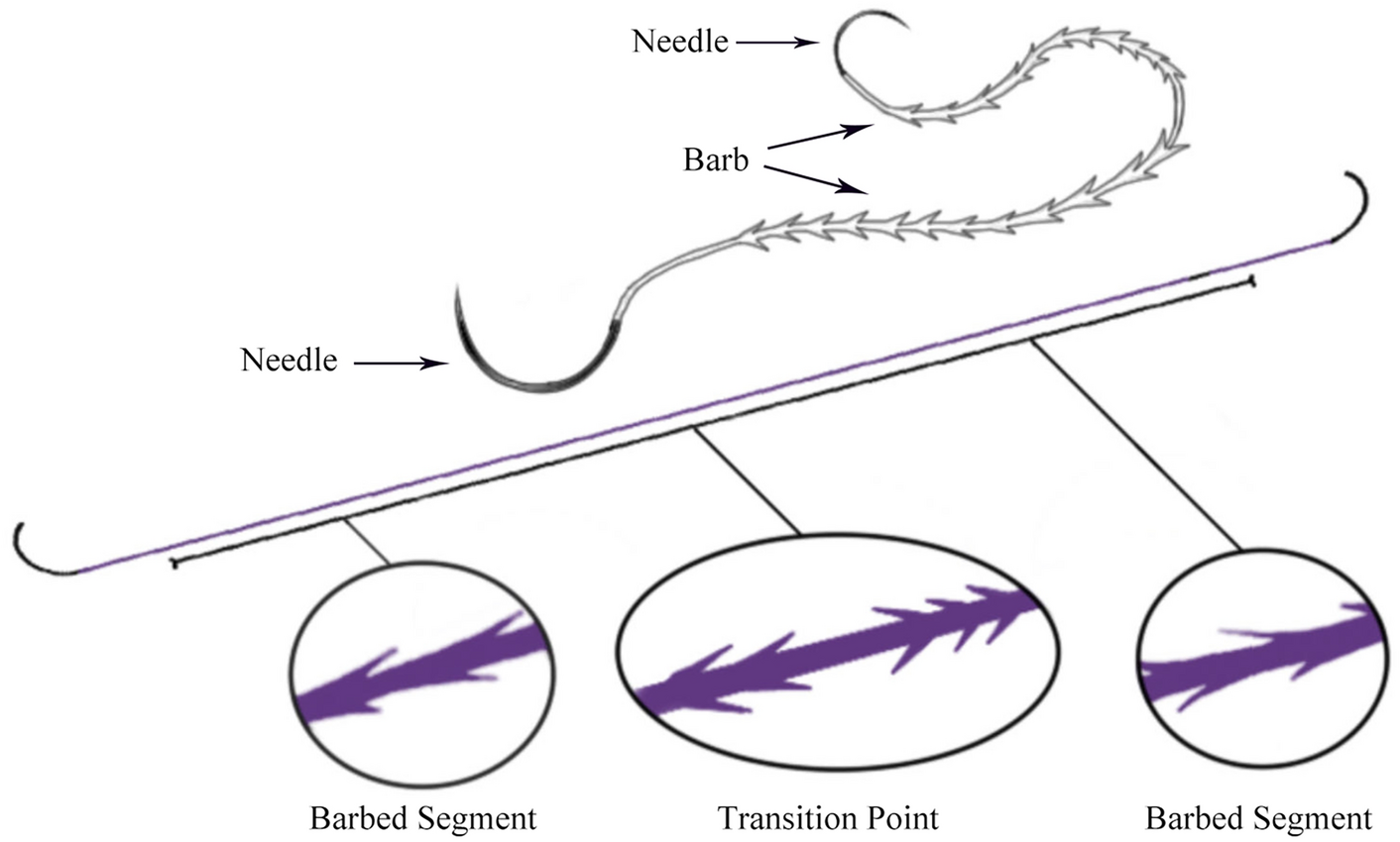 Application of double-needle bi-direction barbed sutures in laparoscopic common bile duct suture: a propensity score matching analysis