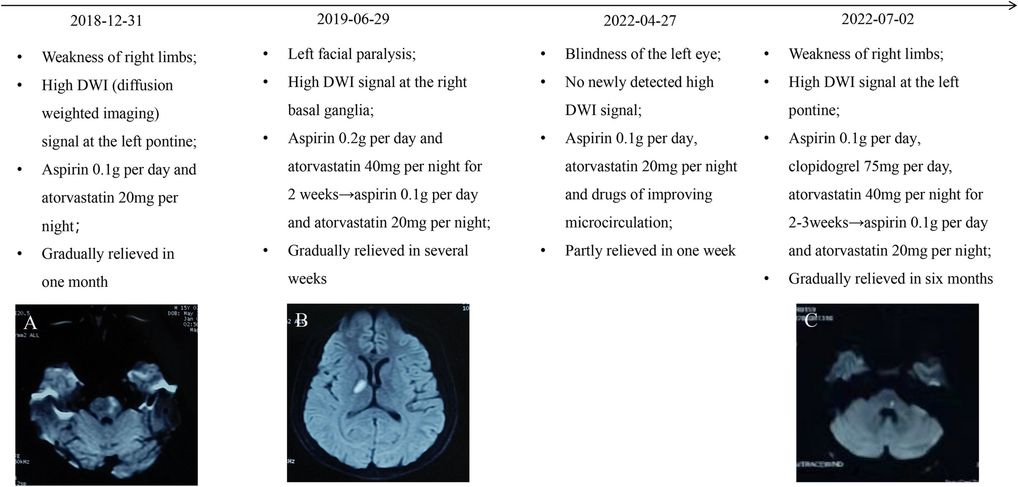 Deficiency of adenosine deaminase 2 (DADA2) with recurrent ischemic stroke, fever and cutaneous changes: A case report