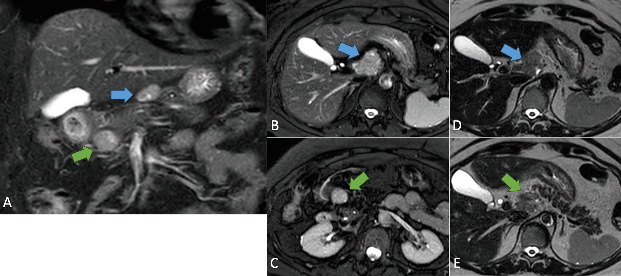 Pancreatic Ductal Adenocarcinoma with Medullary Features and a Complete Pathological Response After Neoadjuvant FOLFIRINOX: A Case Report and Literature Review