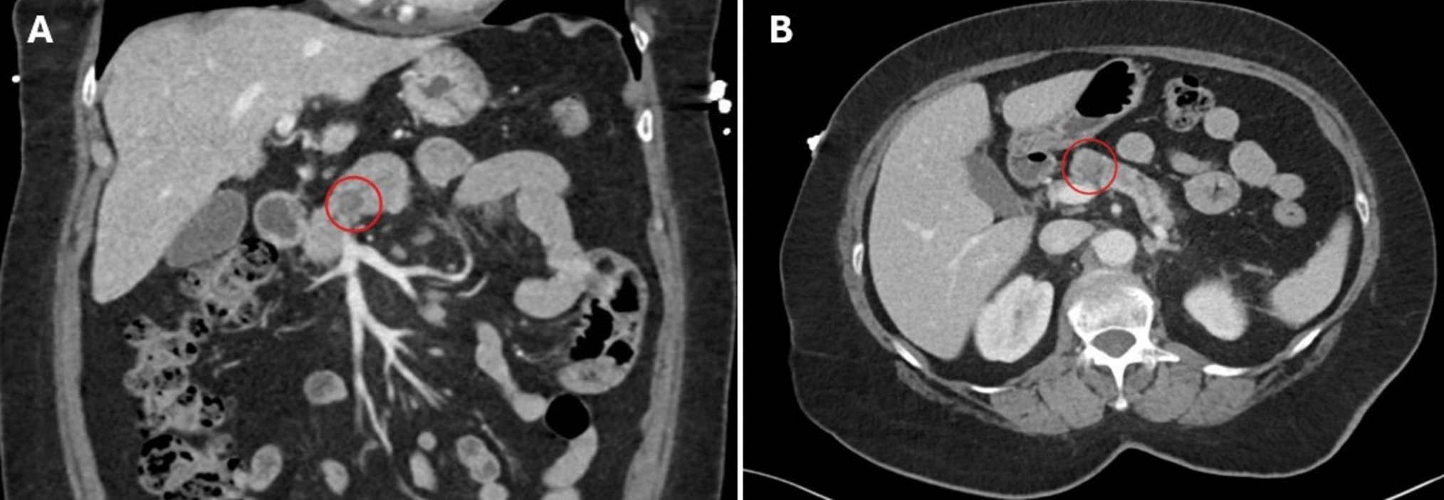 Oldest Reported Case of Solid Pseudopapillary Neoplasm: Diagnostic Challenge and Surgical Management