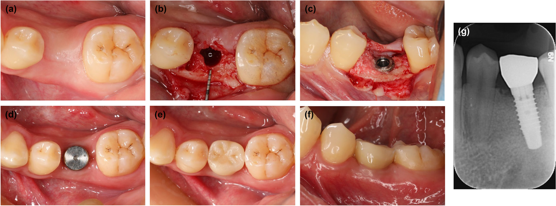 Influence of buccal mucosa width/height ratio, emergence profile and buccal bone width on peri-implant tissues: a prospective one-year study