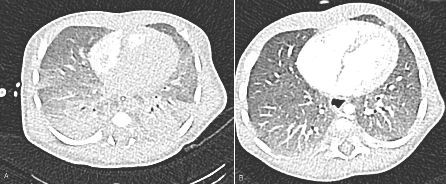 Off-Label Use of Anakinra in Inflammatory Conditions in Neonates and Infants Up to 3 Months of Age: A Case Series and a Review of the Literature