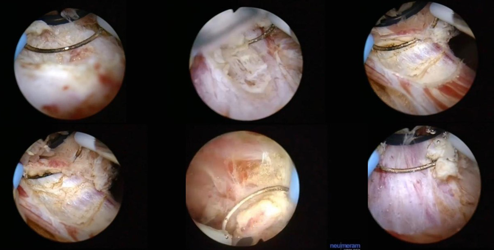 In all fields anatomical dissection has improved results - en bloc resection of bladder tumors (ERBT) will make no exception