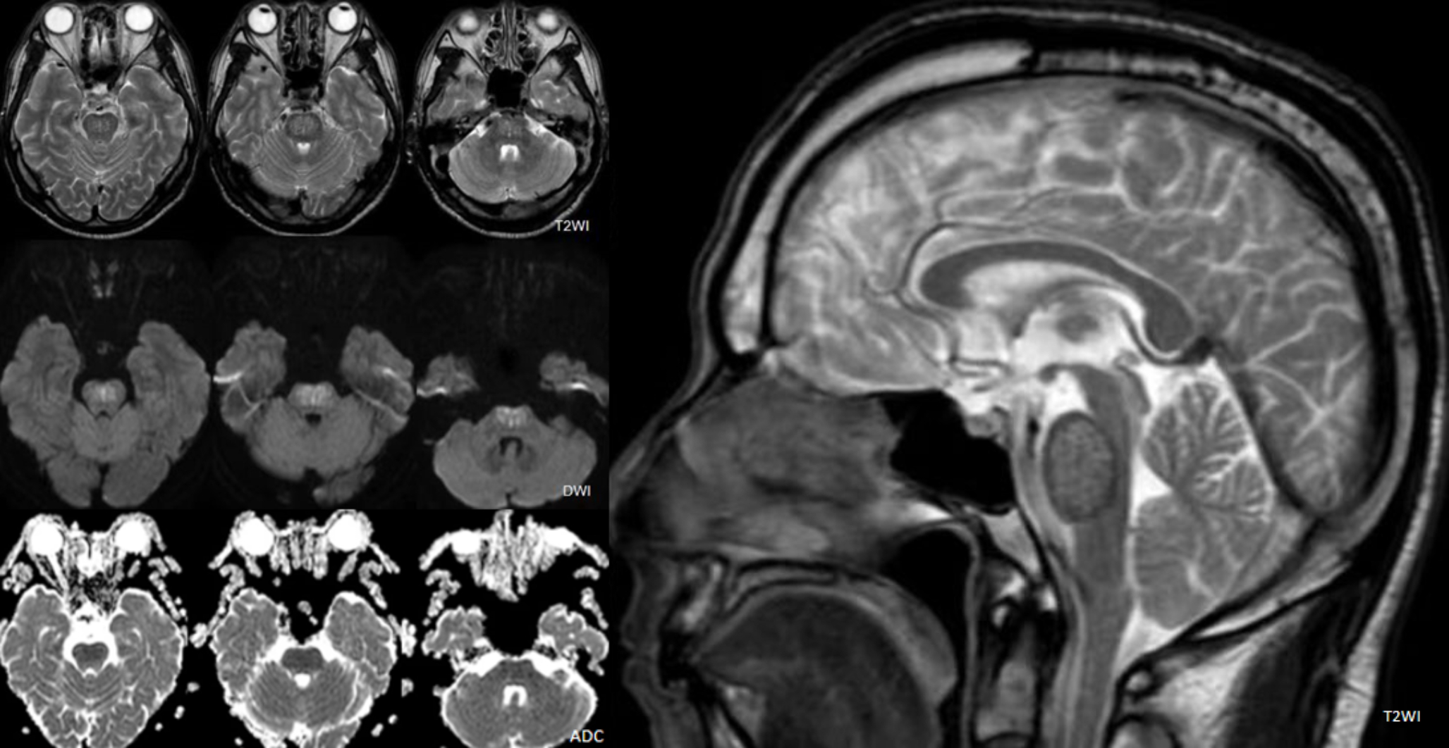 The sieve mesh sign of central pontine myelinolysis in diabetic ketoacidosis