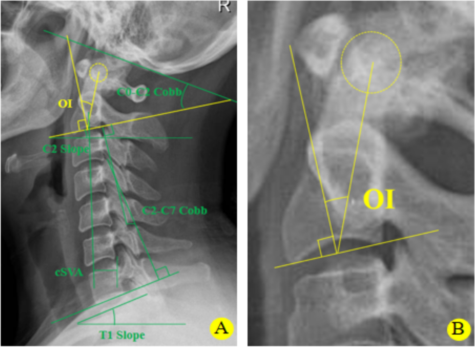 Correlation analysis between preoperative odontoid incidence and clinical outcomes 2 years after anterior cervical discectomy and fusion