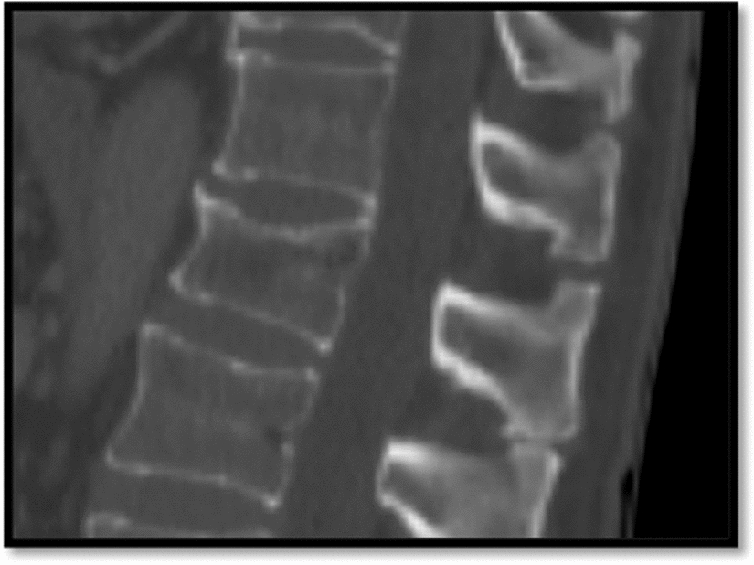 Opportunistic Hounsfield units measurements on computed tomography scans can predict the number of prevalent vertebral compression fractures in older adults