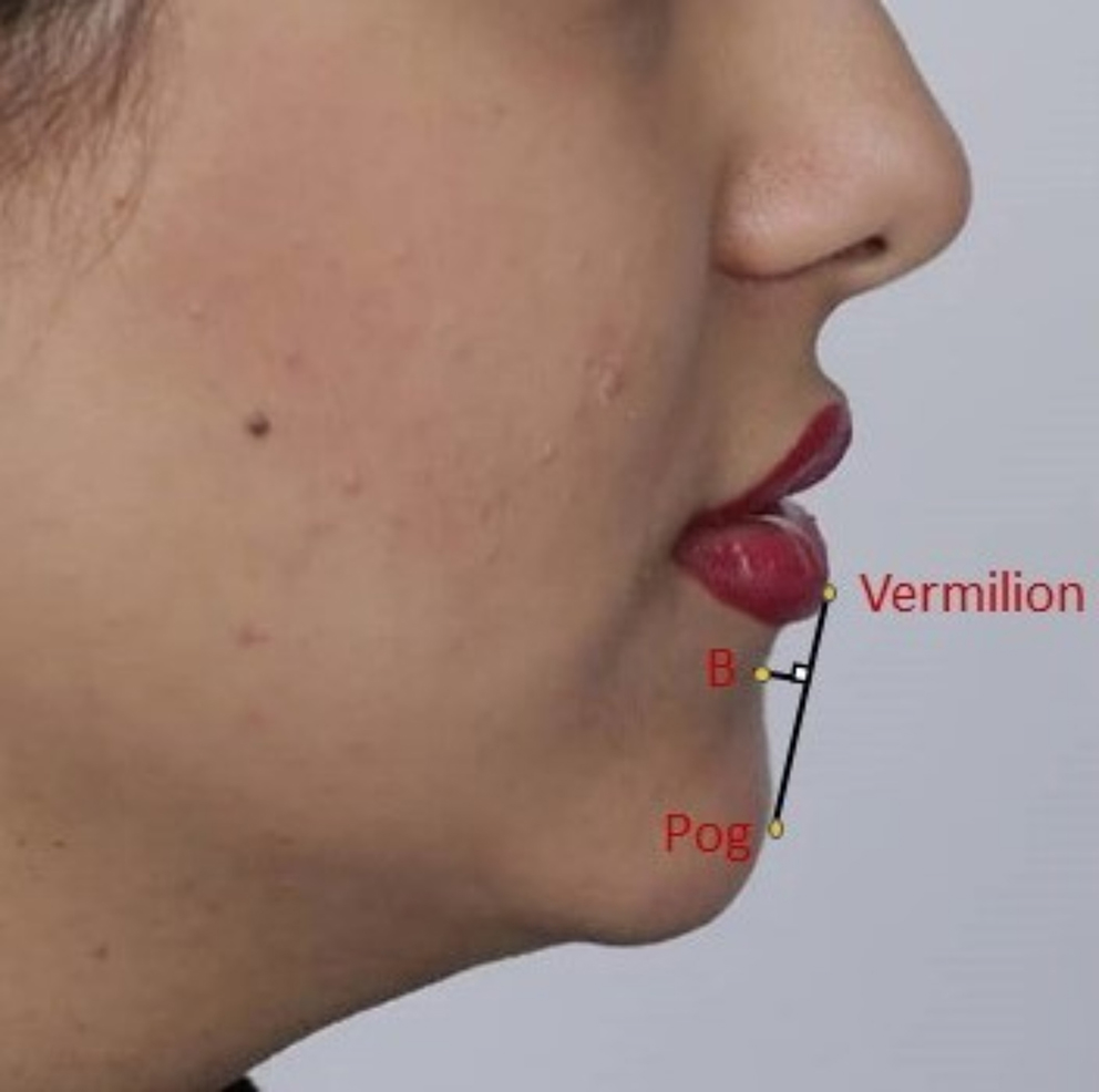 Ideal mentolabial sulcus depth in long-face, short-face, and normal-face in female individuals