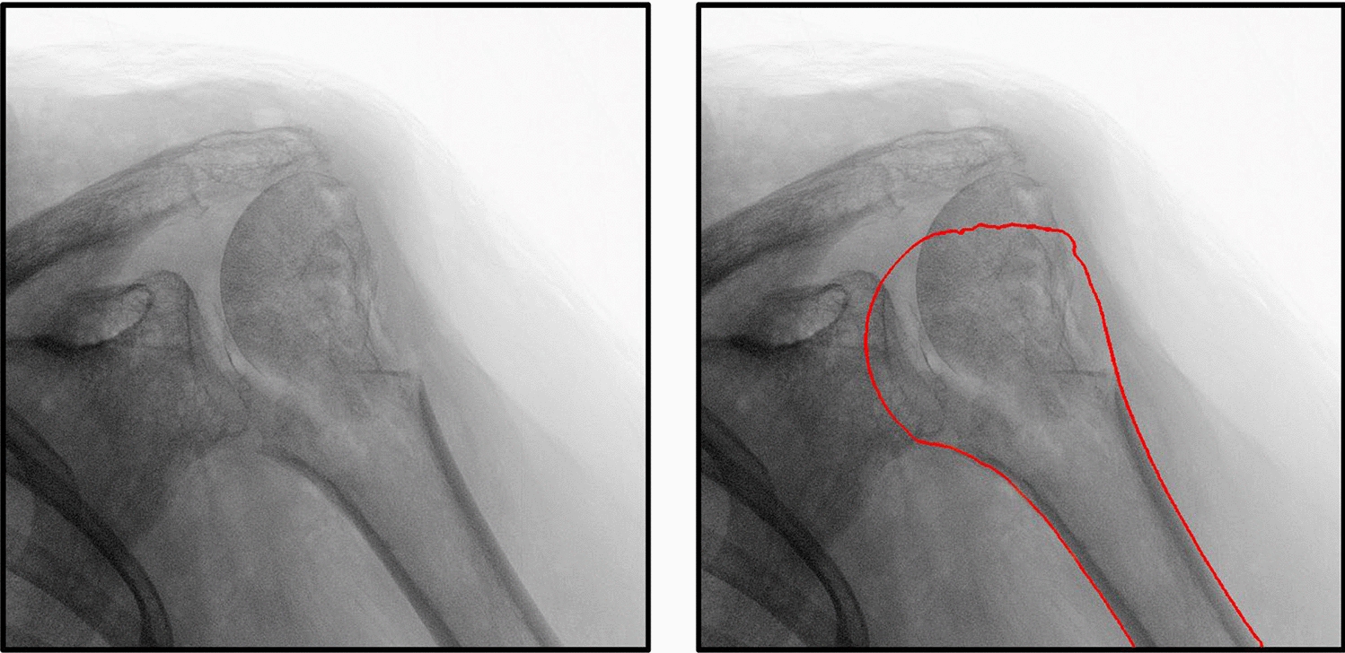 Shape-matching-based fracture reduction aid concept exemplified on the proximal humerus—a pilot study