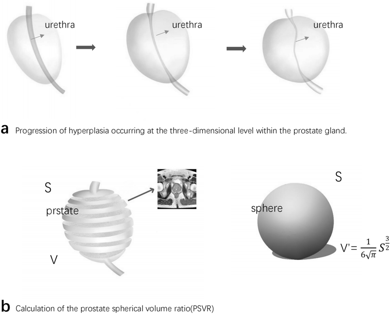 The predictive value of prostate spherical volume ratio in lower urinary tract symptoms and clinical progression of benign prostatic hyperplasia: a retrospective cohort study