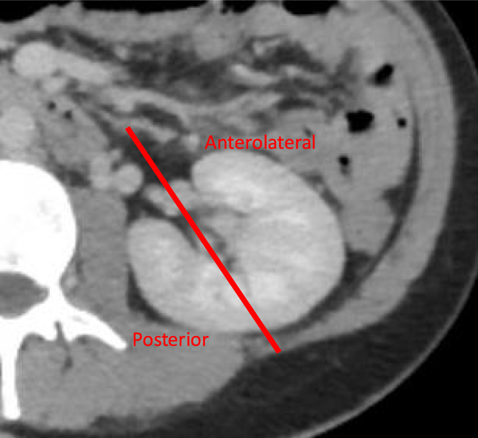 Transperitoneal robot-assisted partial nephrectomy: a comparison of operative and oncological outcomes between posterior and anterolateral tumours