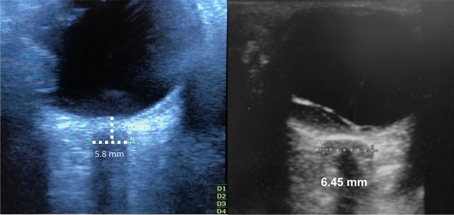 Ultrasonographic evaluation of optic nerve sheath diameter in patients severe traumatic brain injury: a comparison with intraparenchymal pressure monitoring