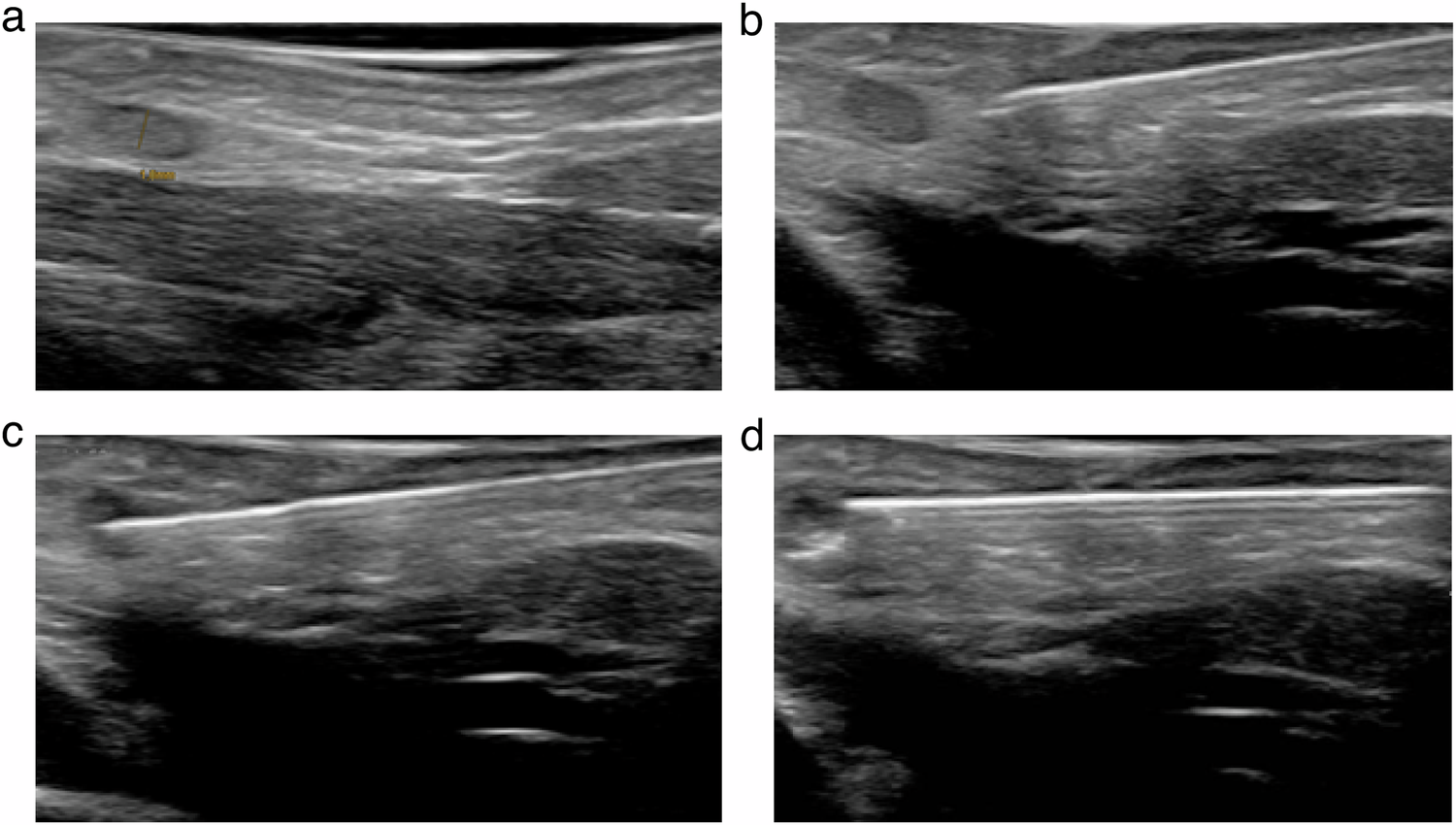 Ultrasound-guided needle positioning confirmation with injection of saline solution for nodal dynamic contrast-enhanced MR-lymphangiography in pediatric patients