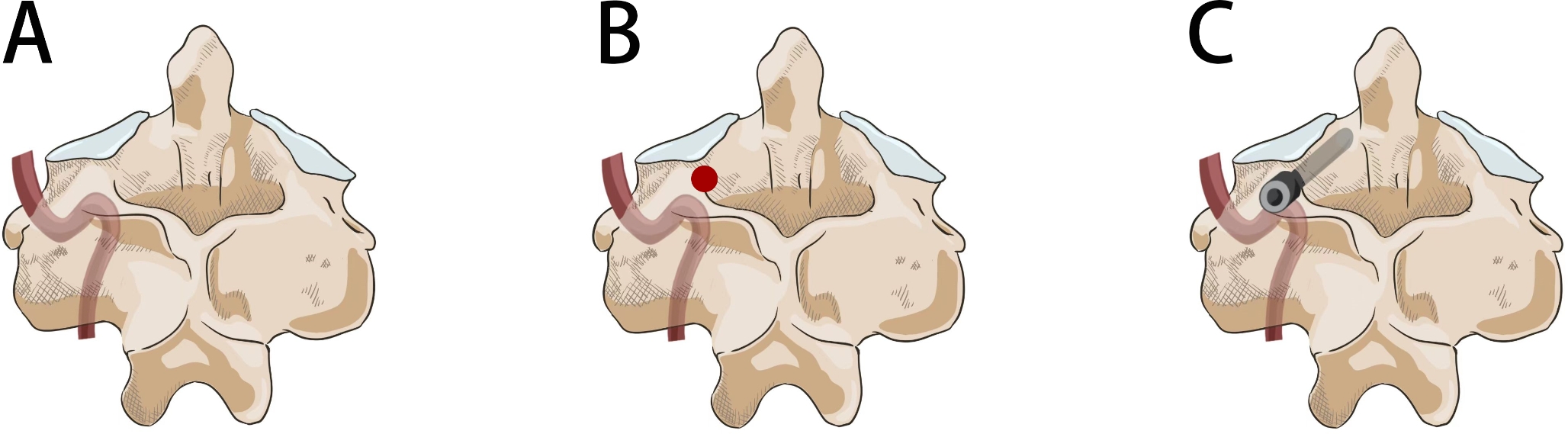 C2 anatomical pedicle screw for C2 fixation under the concept of atlantoaxial joint distraction and fusion with intra-articular cages: technical note