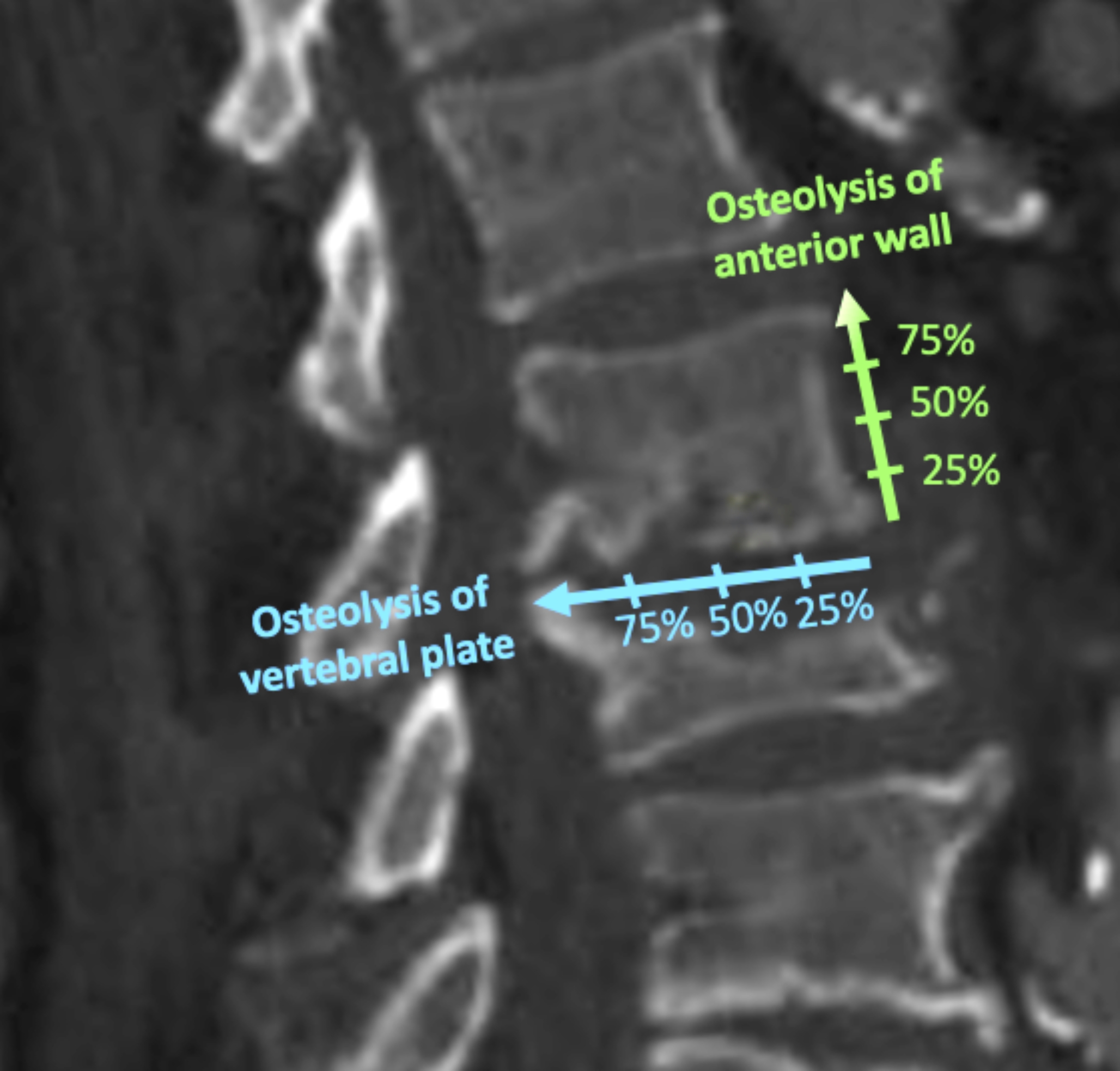 What are the risk factors for neurological complications and spinal deformity in patients with infectious spondylodiscitis?