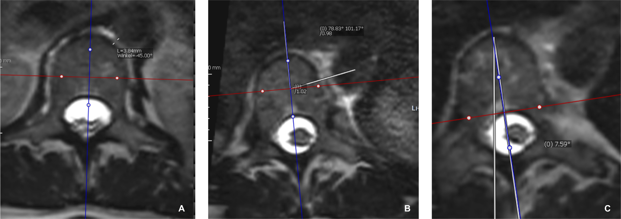 The aortic-vertebral distance is more associated with axial plane deformities than coronal and sagittal deformities in idiopathic scoliosis patients of Lenke types I and II.