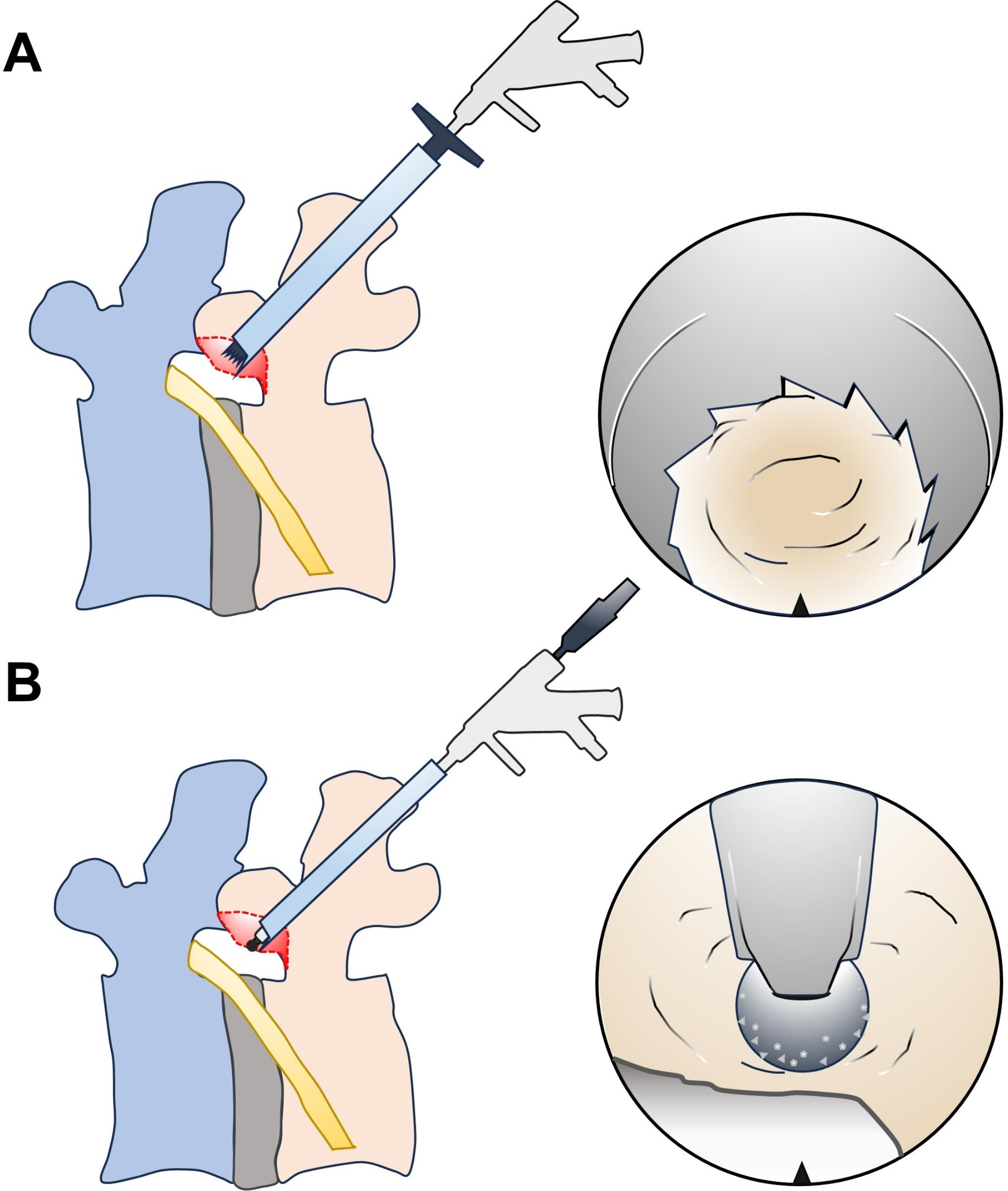 A comparative study of two full-endoscopic foraminoplasty techniques for lumbar disc herniation